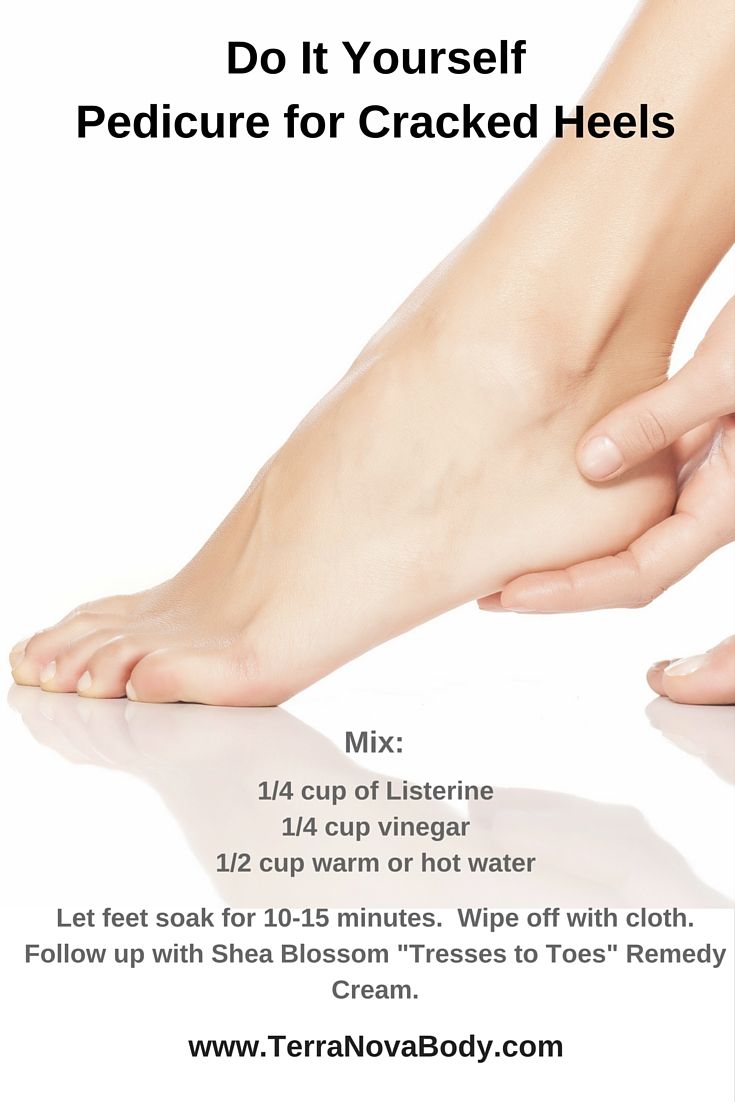 Best treatment for sore cracked heels